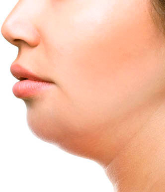 Tratamento para papada